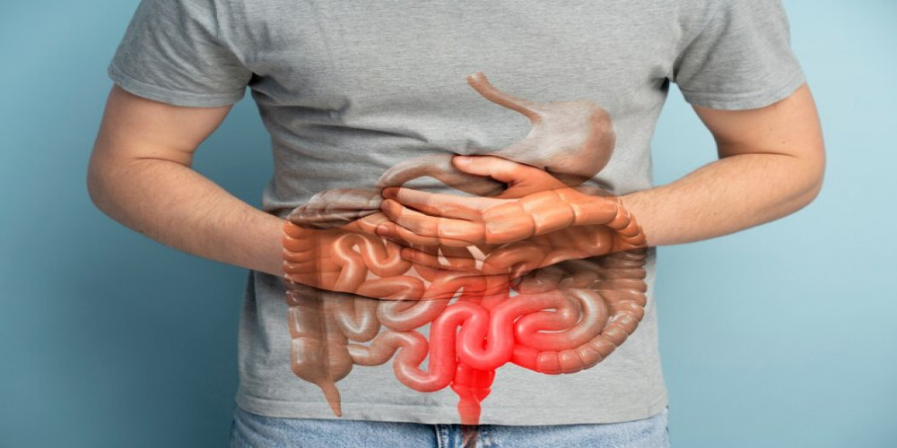A Comprehensive Guide to Treating Inflammatory Bowel Disease