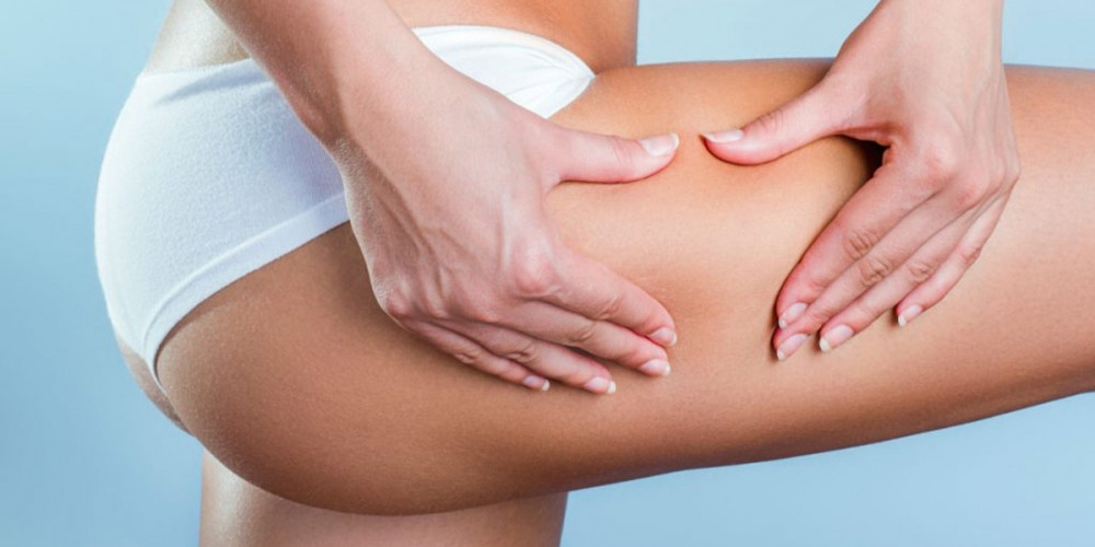 Beyond the Pinch Test: Laser Solutions for Stubborn Cellulite