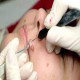 Mole Removal Treatment in Dubai: A Comprehensive Overview
