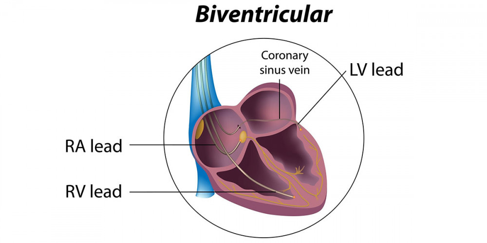 Cardiac Resynchronization Therapy: A Lifeline for Heart Health