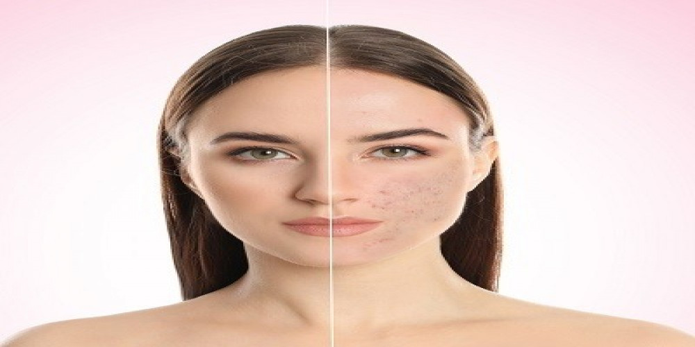 Premier Acne Treatment Centers in Islamabad