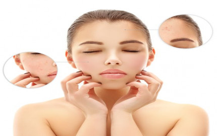 Acne Scars Treatment in Dubai: Is Acne Scars Only Affect Teenagers?