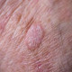 Protecting Your Hands from Actinic Keratosis