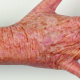 Understanding the Progression of Actinic Keratosis on Hands