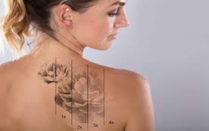  Transforming Perspectives: Laser Tattoo Removal in Islamabad