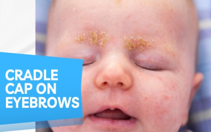 Cradle Cap on Eyebrows - Symptoms, Causes, and Treatment