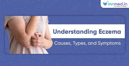 Understanding Eczema: Causes, Types, and Symptoms