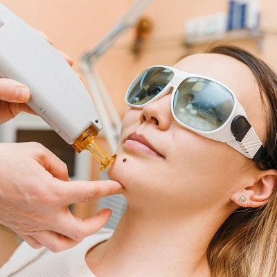 The Art of Laser Mole Removal: A Painless Path to Flawless Skin