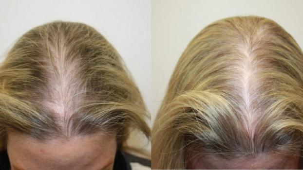 Solving Common Hair Problems with Fresno Hair Solutions: Regain Your Luscious Mane