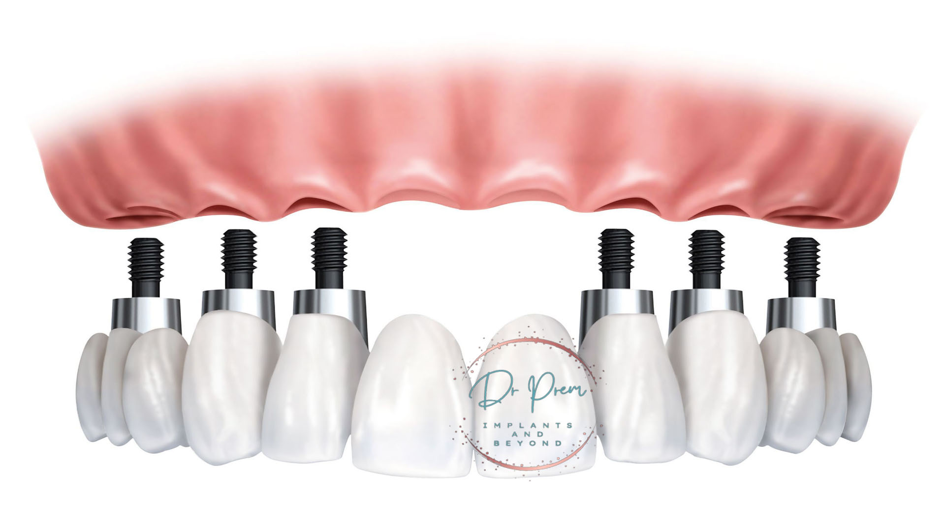 All-on-6 vs. Single Tooth Implants: A Comprehensive Guide (DoctorPrem)