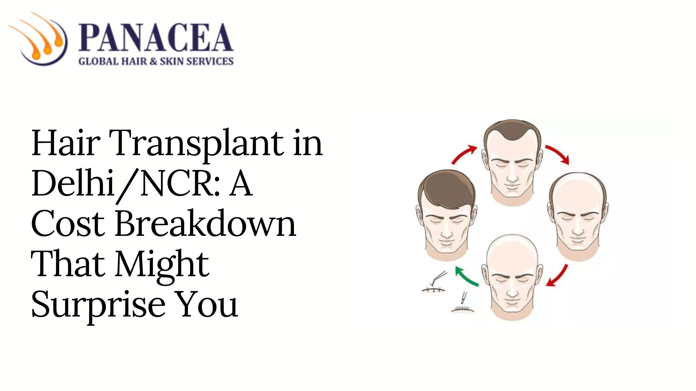 Hair Transplant in Delhi/NCR: A Cost Breakdown That Might Surprise You