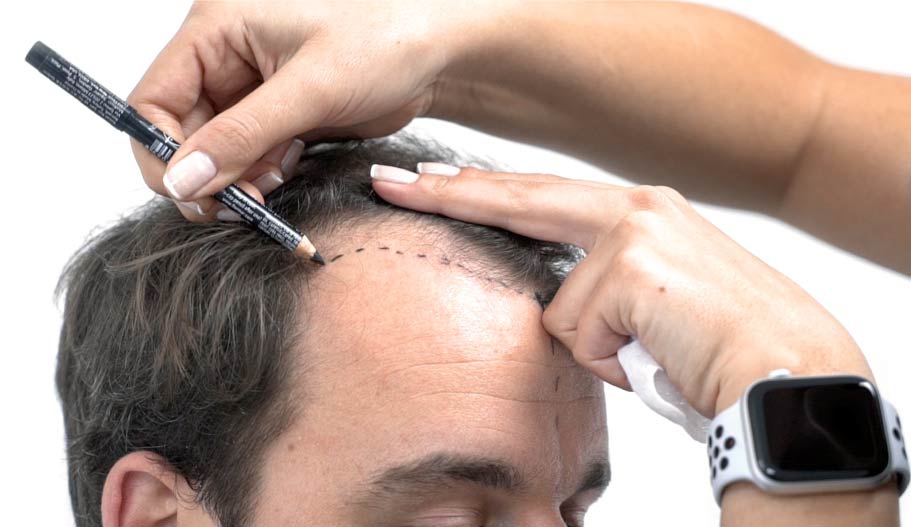 Reviving Confidence: A Comprehensive Look at Hair Transplantation