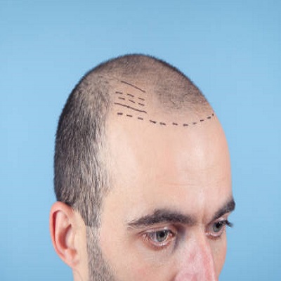 "Strands of Confidence: Navigating the Path to the Best Hair Transplant Surgeon"
