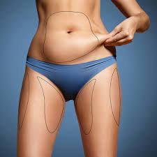 Balancing Budget And Beauty: Tips For Affordable Liposuction In Riyadh