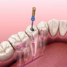 Delving into Advanced Dental Solutions: The Precision of Root Canal Therapy in Islamabad