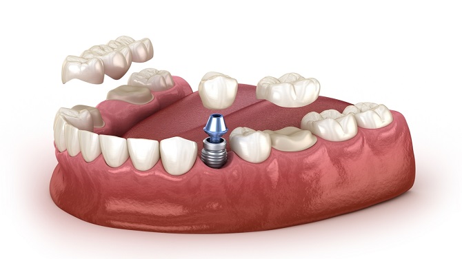  "Revitalize Your Smile: Exploring the Wonders of Dental Implants"