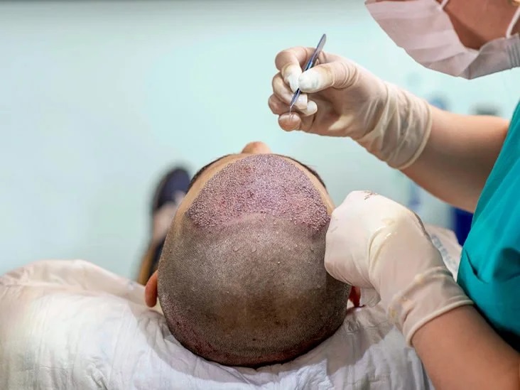 Top 7 Myths Debunked About Hair Transplant Procedures