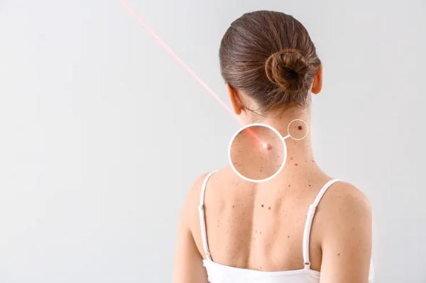 Precision Dermoscopy for Mole Assessment in Dubai
