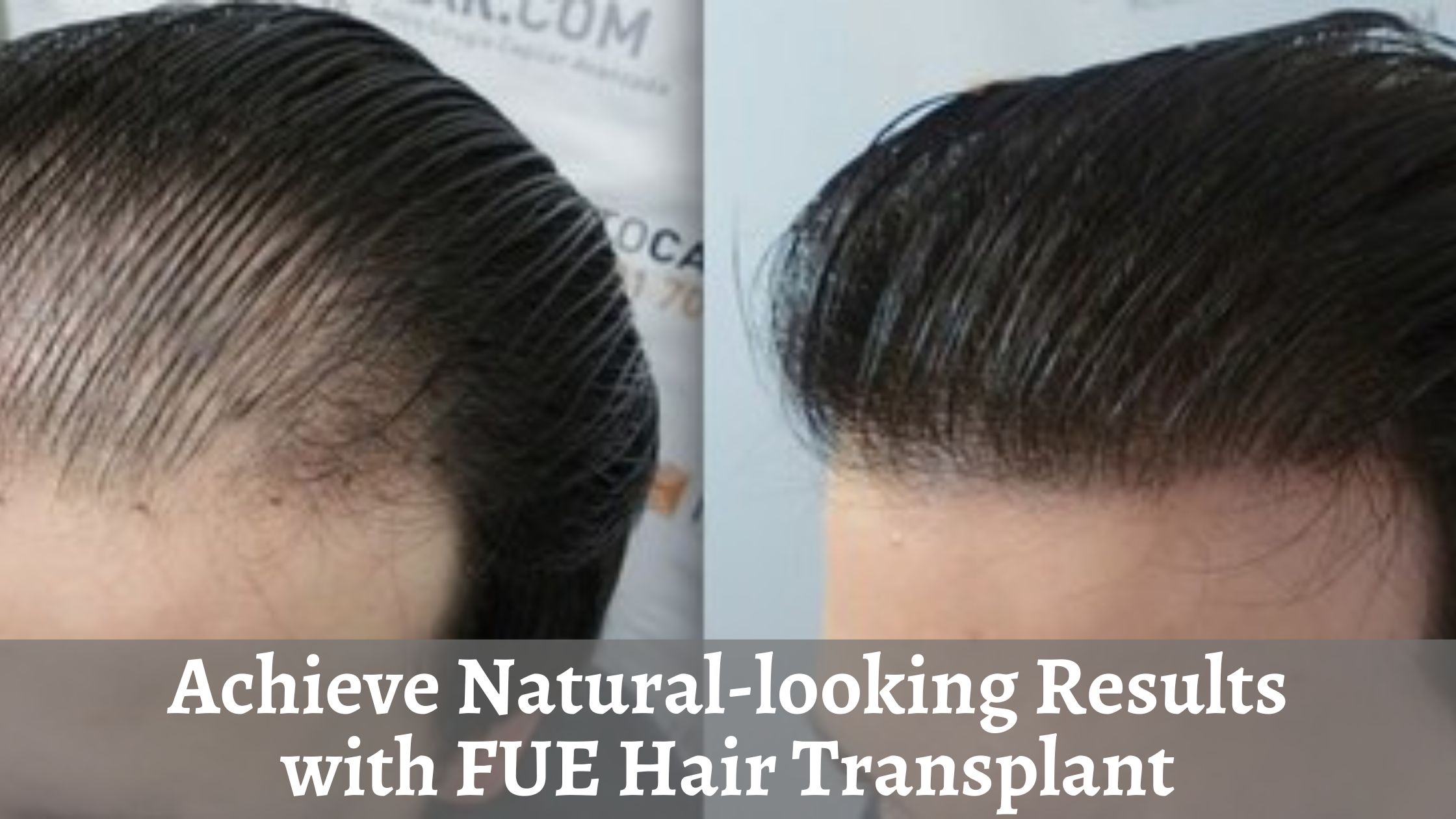 Achieve Natural-looking Results with FUE Hair Transplant