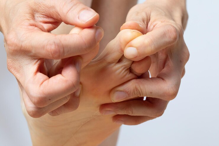 What are Plantar warts? Diagnosis and treatment