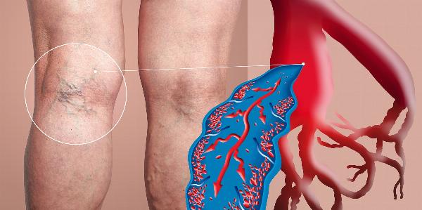 Global Deep Vein Thrombosis Market 2023 - Top Key Players Analysis Report Till 2032