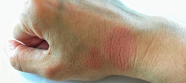 Cutaneous Lupus Erythematosus Market Size, Key Players Analysis And Forecast To 2032 | Value Market Research