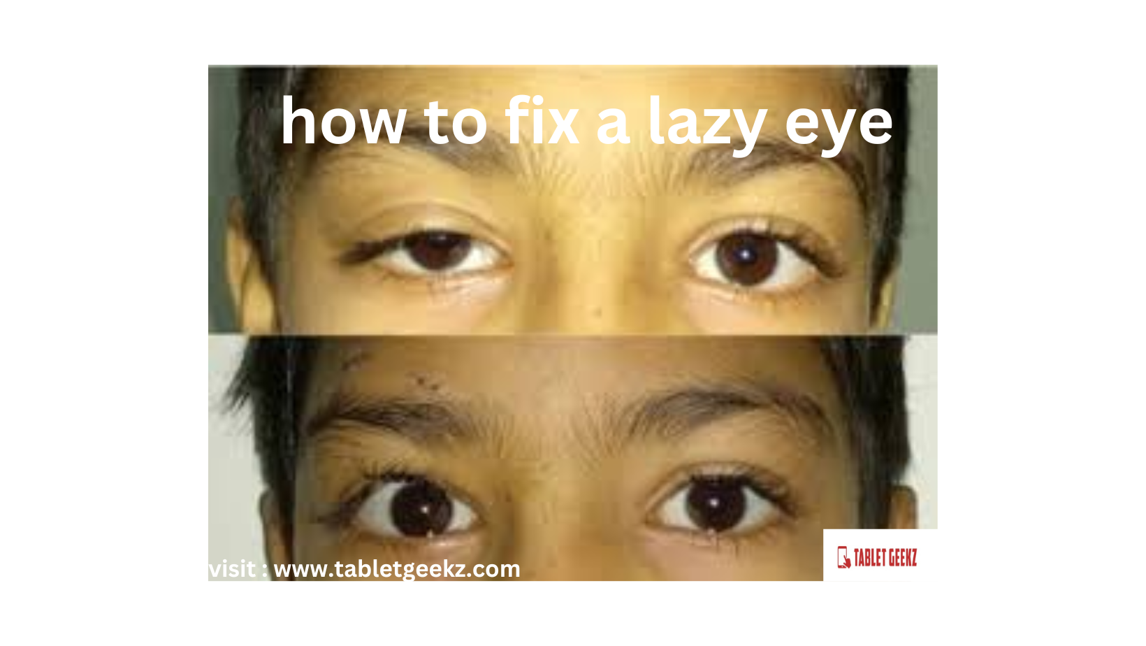 Correcting a Lazy Eye: Understanding Treatment Options