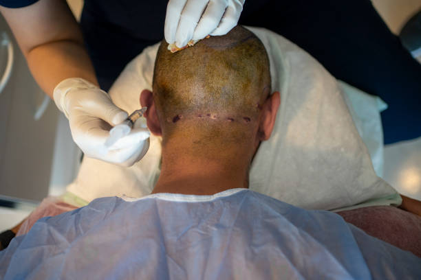 Unlocking Self-Confidence: The Journey of Hair Transplantation