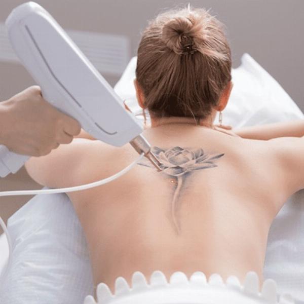 Understanding Laser Tattoo Removal: A Comprehensive Guide