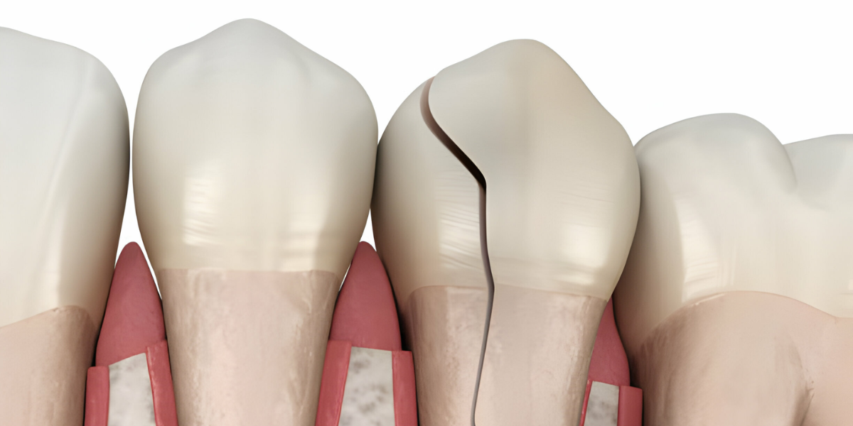 Understanding When a Broken Tooth Needs Urgent Care