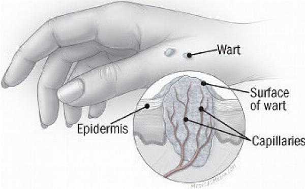 The Best DIY Wart Removal Recipe Using Natural Ingredients