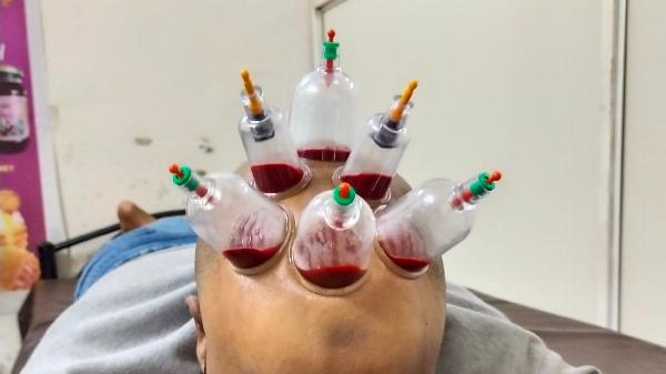 Hijama Treatment Center: Restoring Health Through Cupping Therapy Services