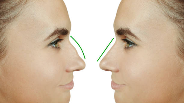 The Non-Surgical Nose Job: Hiko Nose Thread Lift