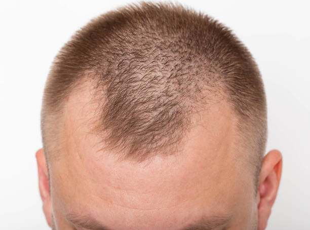 The Science Behind Hair Replacement: How It Works