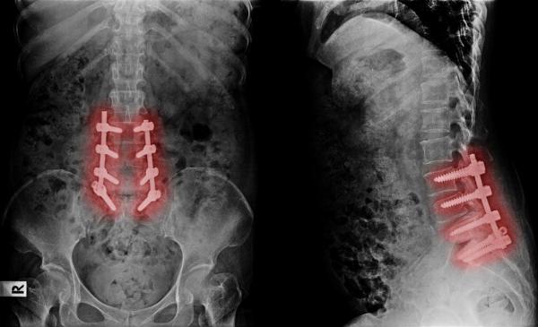 Failed Back Surgery Syndrome Market Size and Growth Rate Analysis for 2024-2034| by IMARC Group