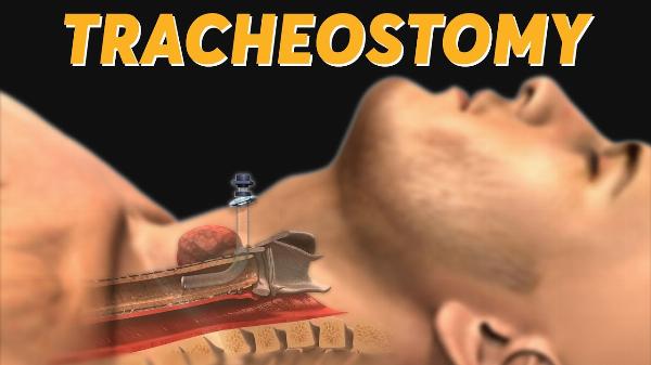 Tracheostomy Market Size, In-depth Analysis Report and Global Forecast to 2032