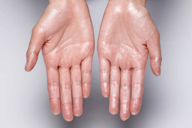 Defeating Excessive Sweating: Hyperhidrosis Solutions in Abu Dhabi