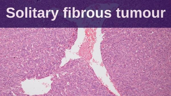 Solitary Fibrous Tumor Treatment Market Size, Share, Growth, Opportunities and Global Forecast to 2032