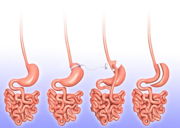 The Science Behind Gastric Sleeve Surgery: What You Need to Know
