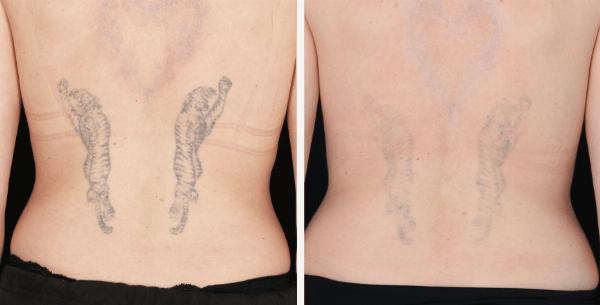 Clarifying the Controversy: Is Laser Tattoo Removal Linked to Cancer?
