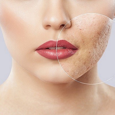 Unlocking Clear Skin: The Ultimate Guide to Acne Scar Treatment in Islamabad