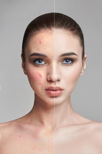 3 Months Tretinoin Still Breaking Out