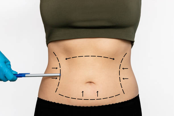 Customizing Your Contours: Abdominal Liposuction in Riyadh