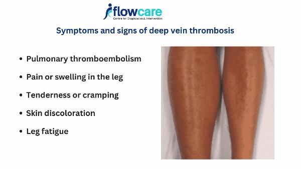 Unveiling the Silent Threat: Recognizing Signs of DVT in the Leg