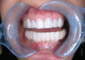 Common Misconceptions About Porcelain Veneers in Preston Debunked