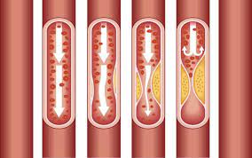 Size and Share of Cardiovascular Calcification Market by 2034