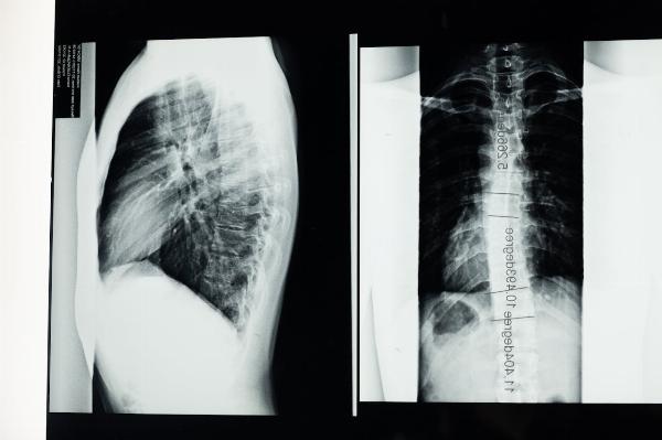Fostering Inclusivity: How Companies Can Support Employees with Scoliosis