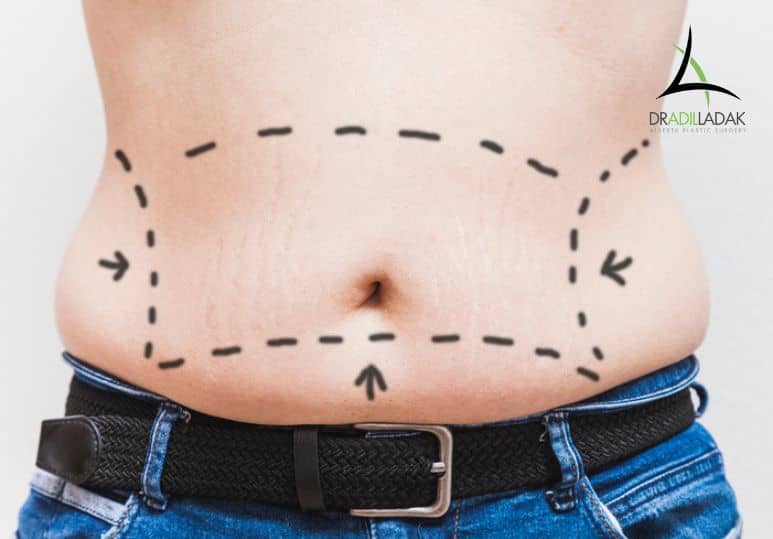 Experience the Power of Transformation: Liposuction Surgery in Riyadh