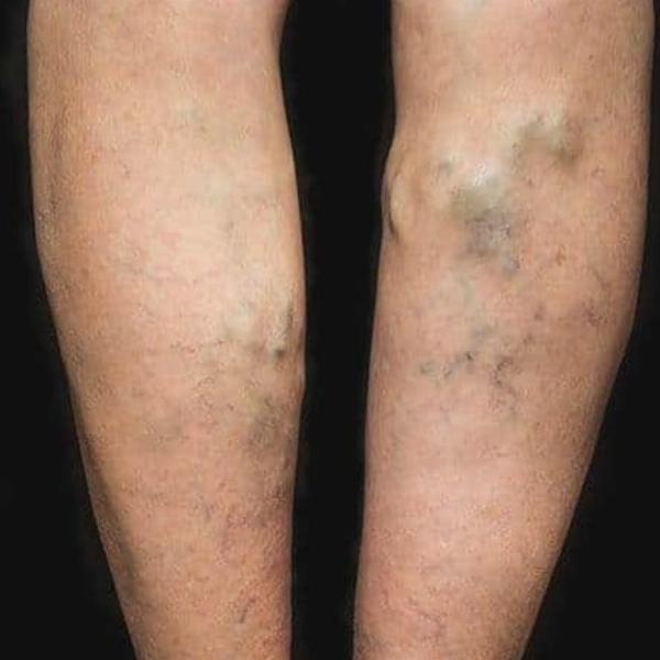 10 Foods to Improve Blood Circulation and Reduce Varicose Vein Symptoms