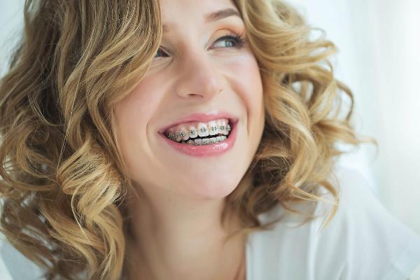 The Ultimate Guide to Dental Braces in Islamabad: What You Need to Know